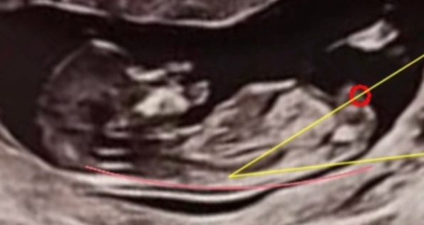 Ultrasound scan showing nub theory analysis